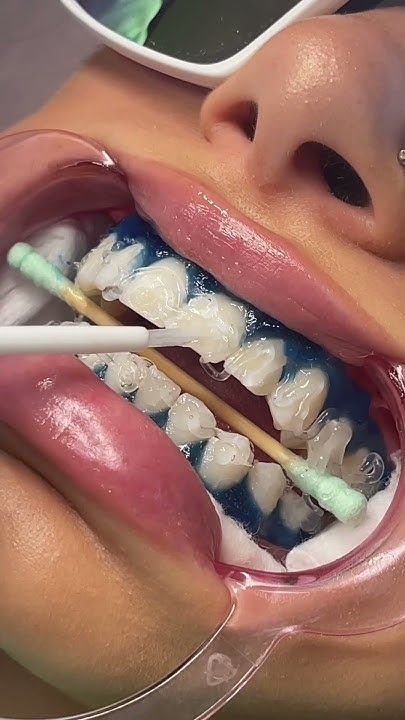 Teeth Whitening